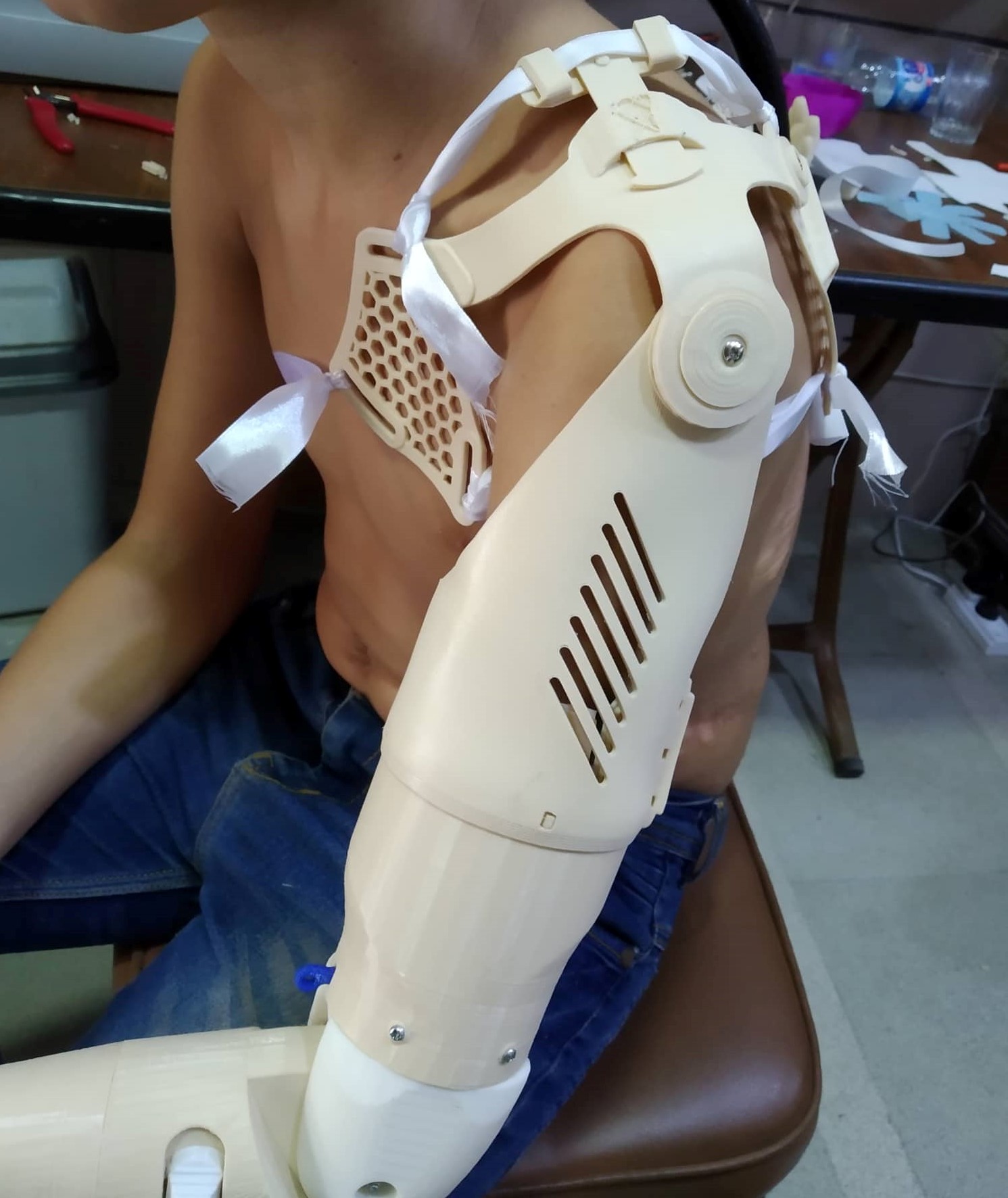 Xos Splint XO-Shoulder assembled – Enabling The Future